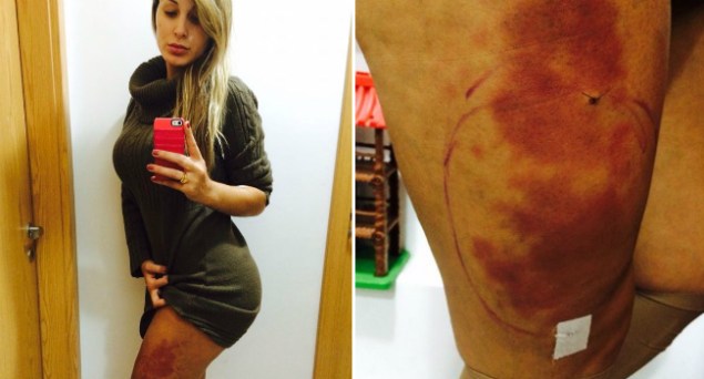 Nas redes sociais, Andressa exibiu edema nas pernas, em decorr&ecirc;ncia da aplica&ccedil;&atilde;o do hidrogel