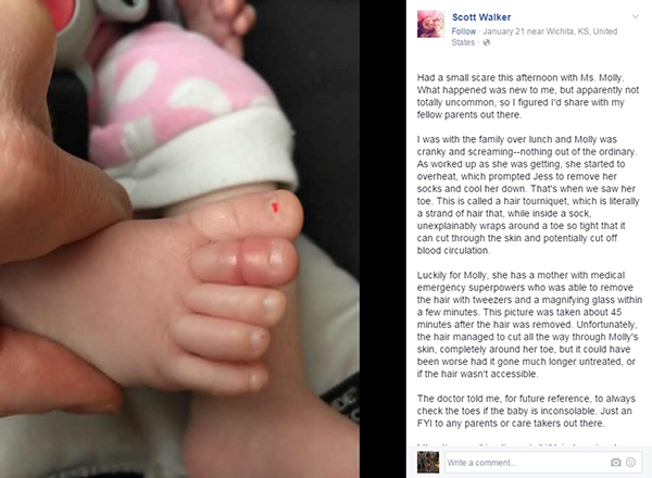 Homem compartilha foto impressionante de filha para alertar outros pais sobre uma perigosa síndrome