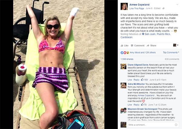 Após sobreviver a uma bactéria “devoradora de carne”, jovem publica foto inspiradora no Facebook