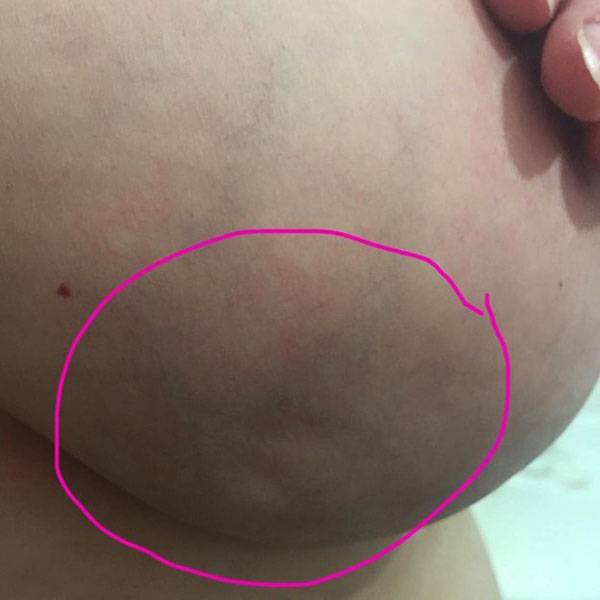 Mulher publica foto de seu seio para alertar sobre um sinal pouco conhecido de câncer de mama