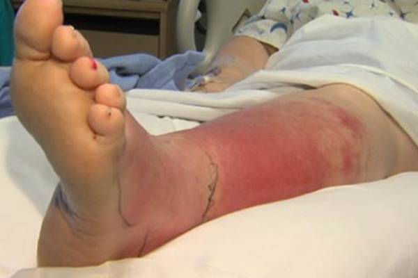 Mulher é internada com infecção grave no pé após fazer pedicure