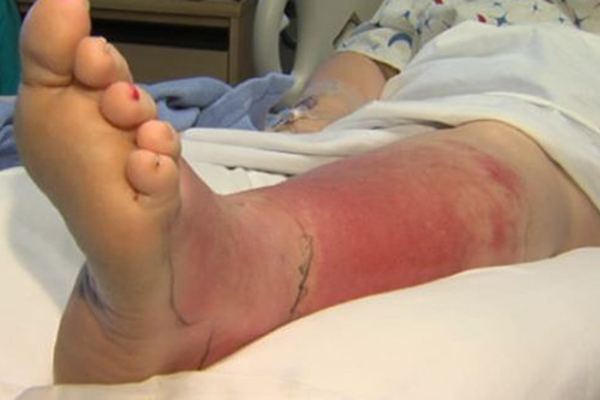 Mulher é internada com infecção grave no pé após fazer pedicure