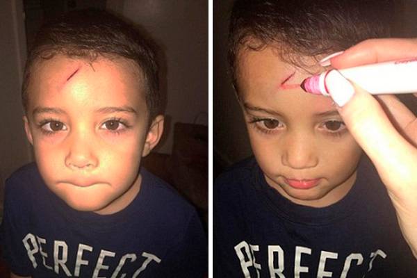 Após acidente doméstico, mãe transforma cicatriz do filho em raio do “Harry Potter”
