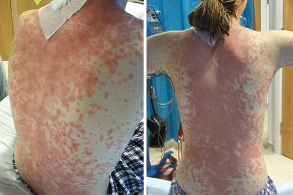 Internada há dez semanas, adolescente enfrenta doença misteriosa após picada de mosquito