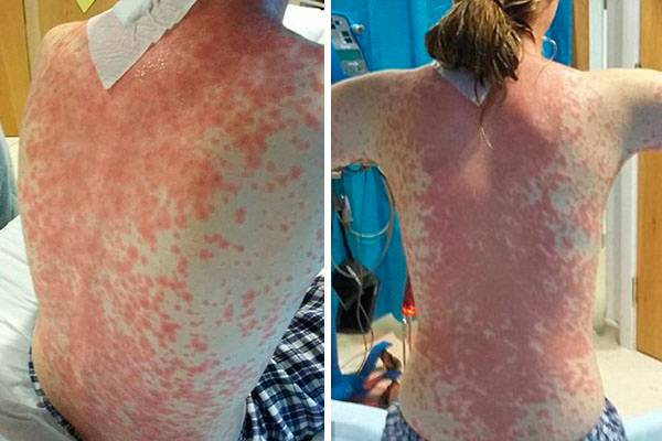 Internada há dez semanas, adolescente enfrenta doença misteriosa após picada de mosquito
