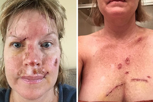 Mãe compartilha fotos chocantes de dia a dia com câncer de pele para fazer alerta