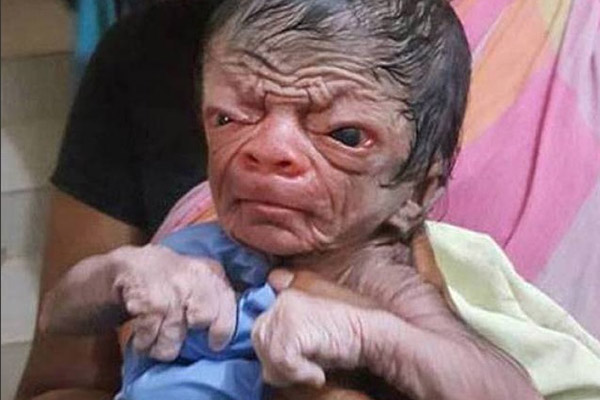 Na internet, bebê com síndrome rara é comparado ao personagem de “O Curioso Caso de Benjamin Button”