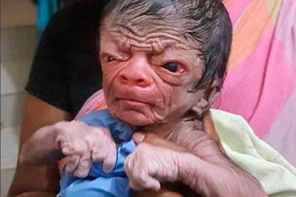 Na internet, bebê com síndrome rara é comparado ao personagem de “O Curioso Caso de Benjamin Button”