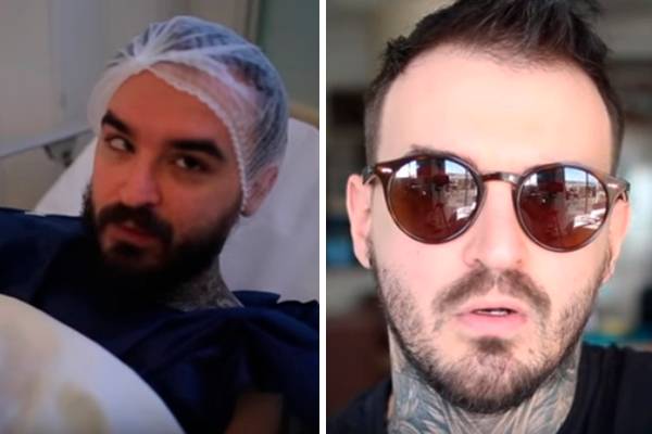 PC Siqueira mostra resultado de cirurgia para corrigir estrabismo e é comparado a Justin Timberlake