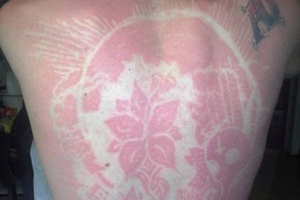 Tatuagens de queimaduras de sol provocam polêmica na internet