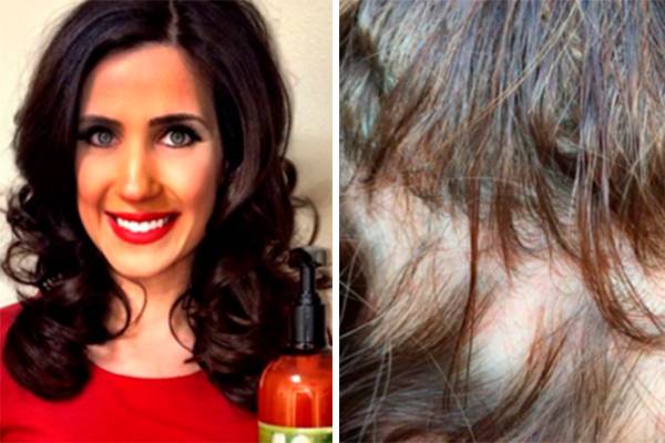 Mulheres estão se unindo após um popular shampoo deixá-las carecas