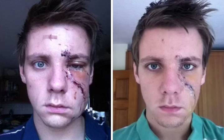 Garoto faz “selfies” durante período de recuperação de ataque que mutilou seu rosto e o resultado é incrível