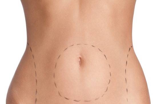 Vai encarar uma lipo? Confira cinco respostas para perguntas frequentes sobre a cirurgia