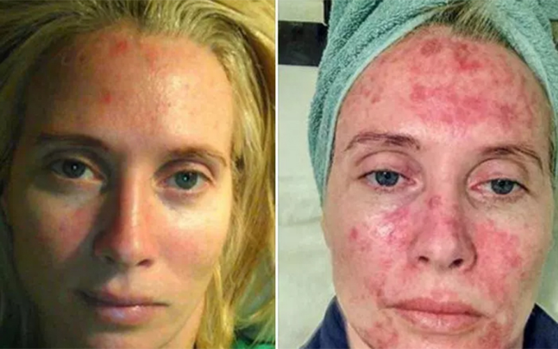 Mulher posta fotos chocantes sobre efeitos do bronzeamento