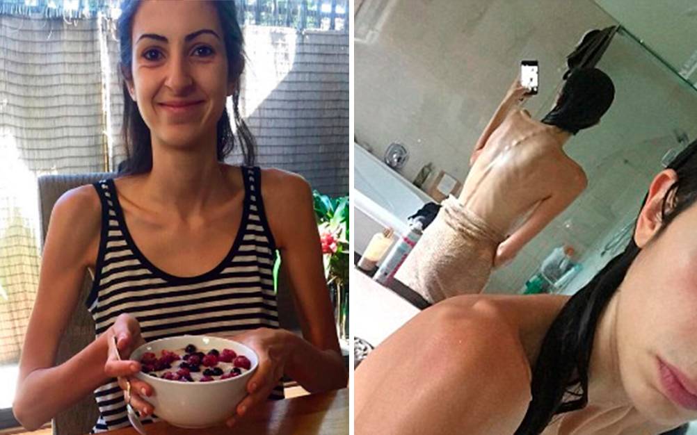 Após um ano, jovem mostra “antes e depois” da anorexia