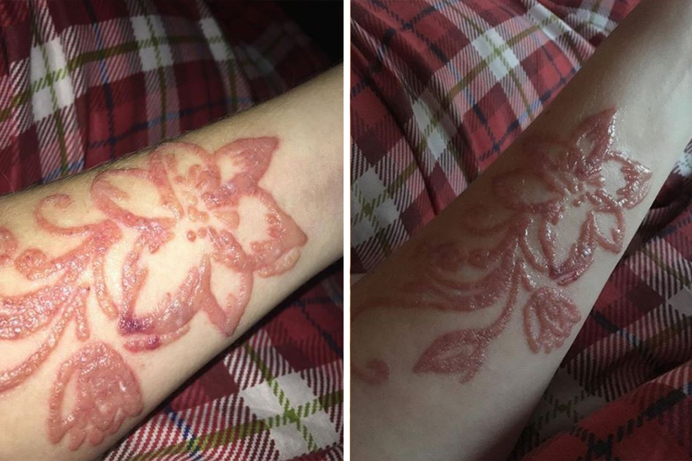 jovem-queimadura-tatuagem-henna-03