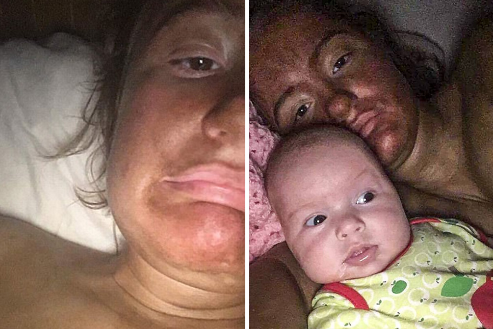 mulher-acidente-autobronzeador-04