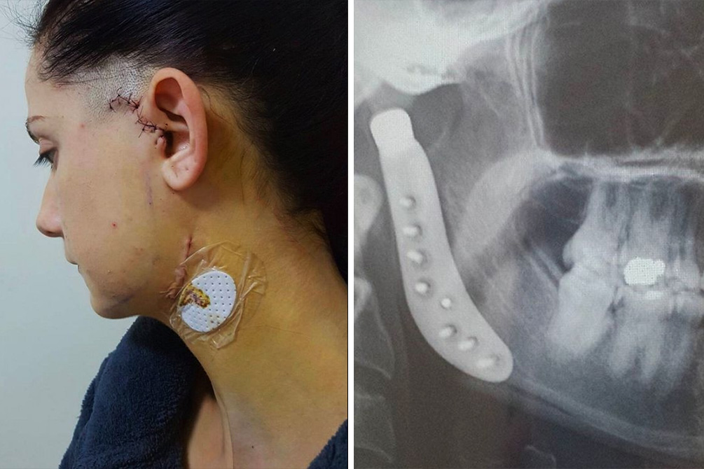 mulher-ignora-sintoma-cirurgia-04