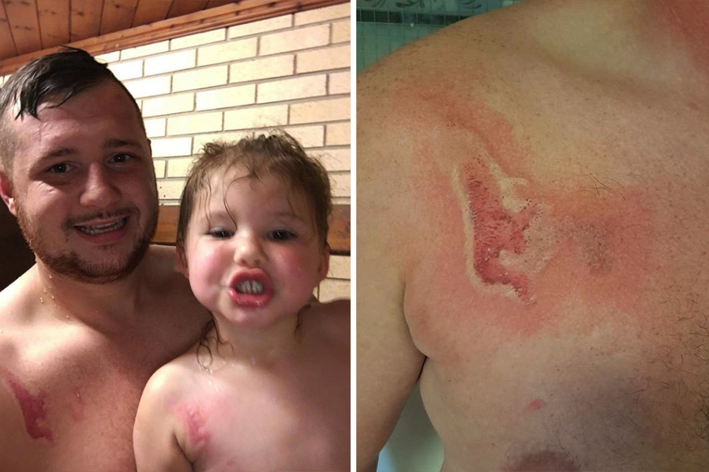 pai-acidente-queimadura-02