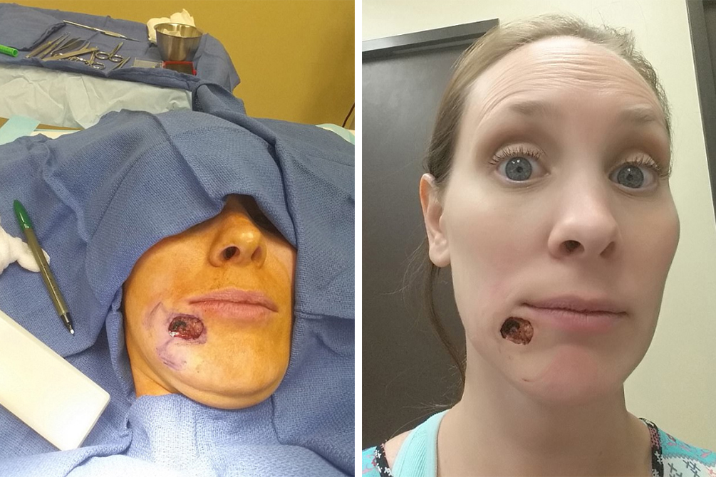 cancer-de-pele-buraco-queixo-01