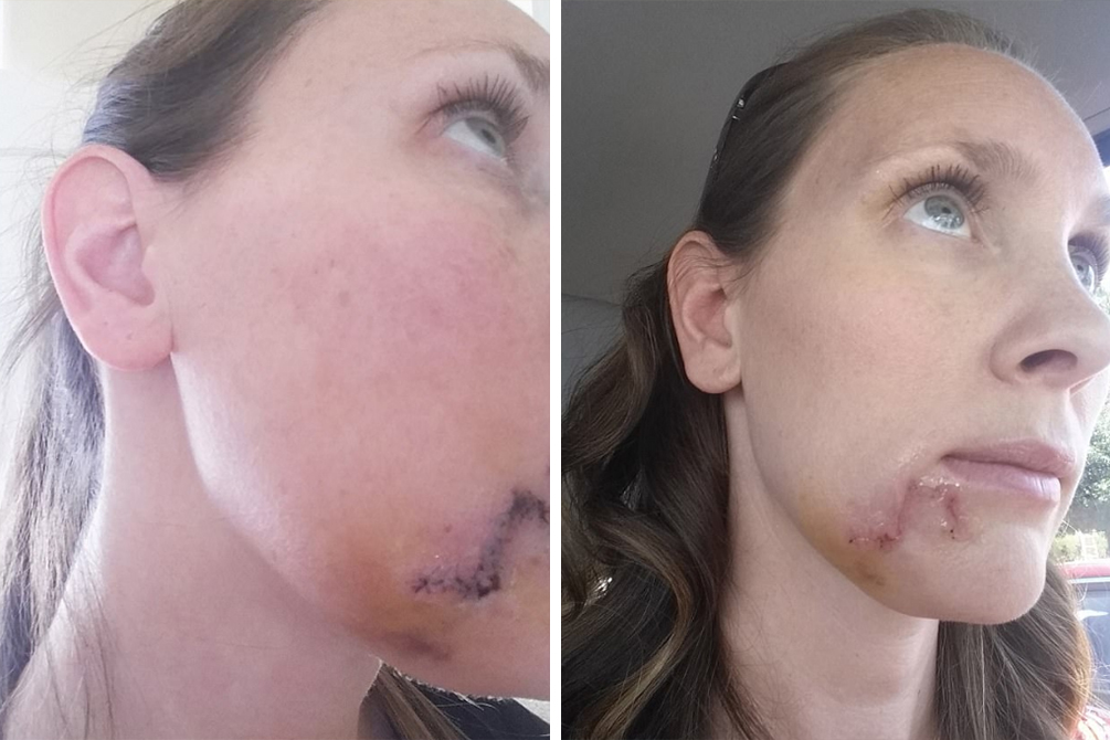 cancer-de-pele-buraco-queixo-02