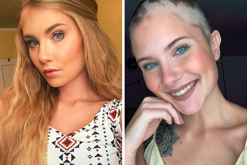 Mãe passa horas pintando cabeça da filha com alopecia para ensaio