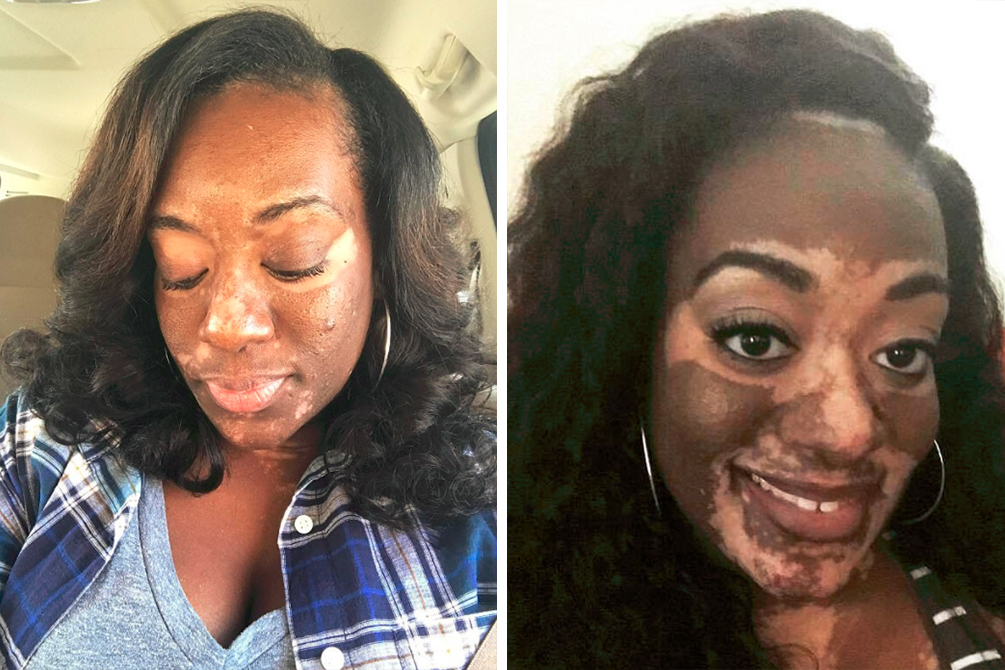 noiva-casamento-vitiligo-02