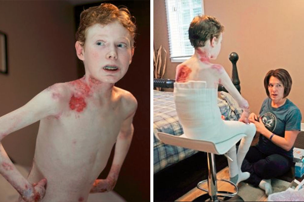 A pele deste adolescente é tão frágil que pode cair ao toque