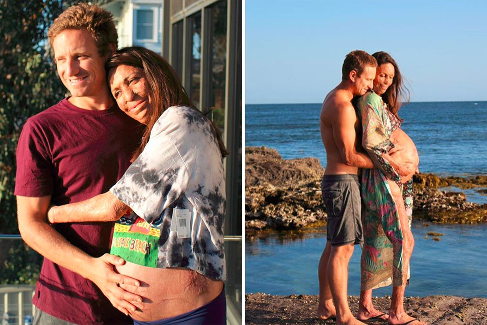 Modelo que teve 65% do corpo queimado dá à luz e mostra bebê