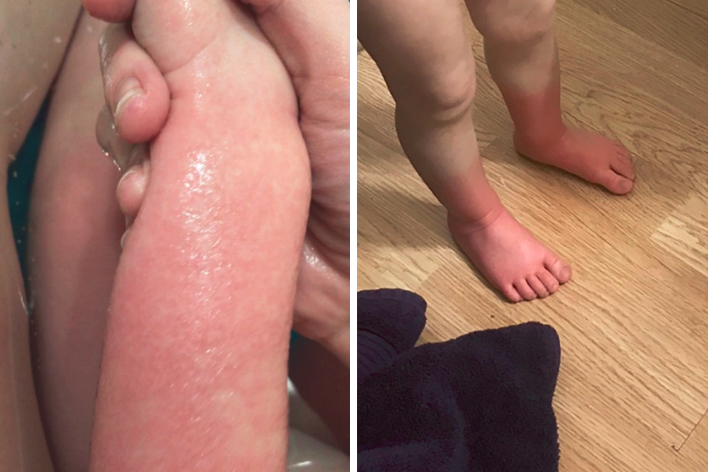 menina-alergia-agua-04