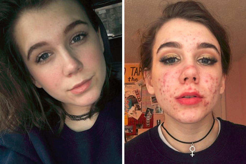 adolescente-cegueira-remedio-espinha-03