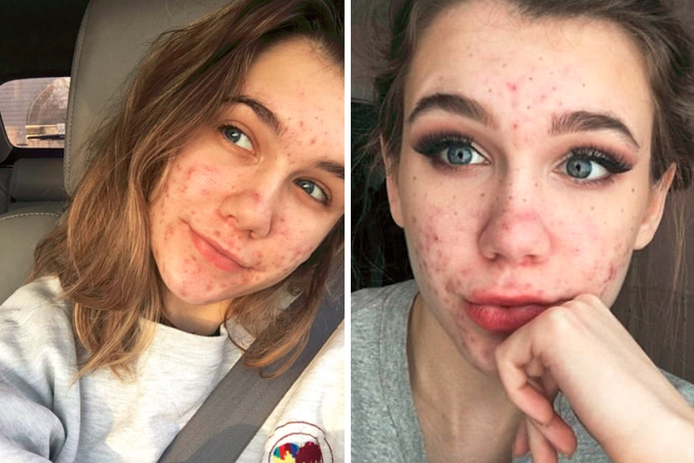 adolescente-cegueira-remedio-espinha-04