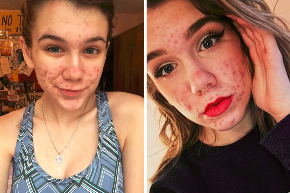 adolescente-cegueira-remedio-espinha-05