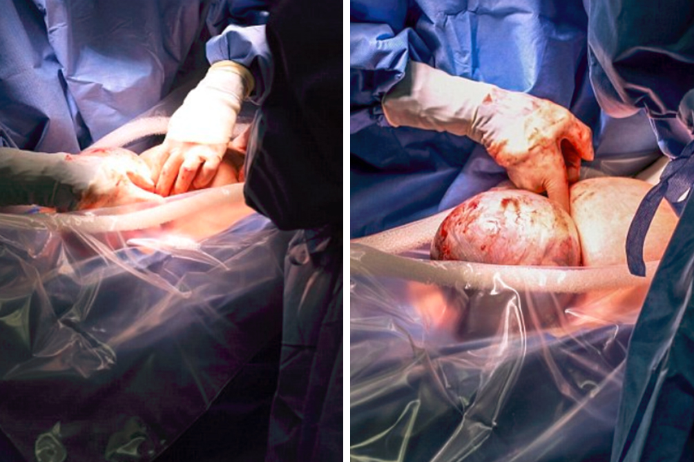 bebe-saco-aminiotico-nascimento-raro-01