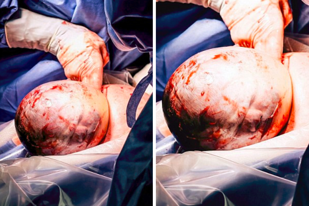 bebe-saco-aminiotico-nascimento-raro-02