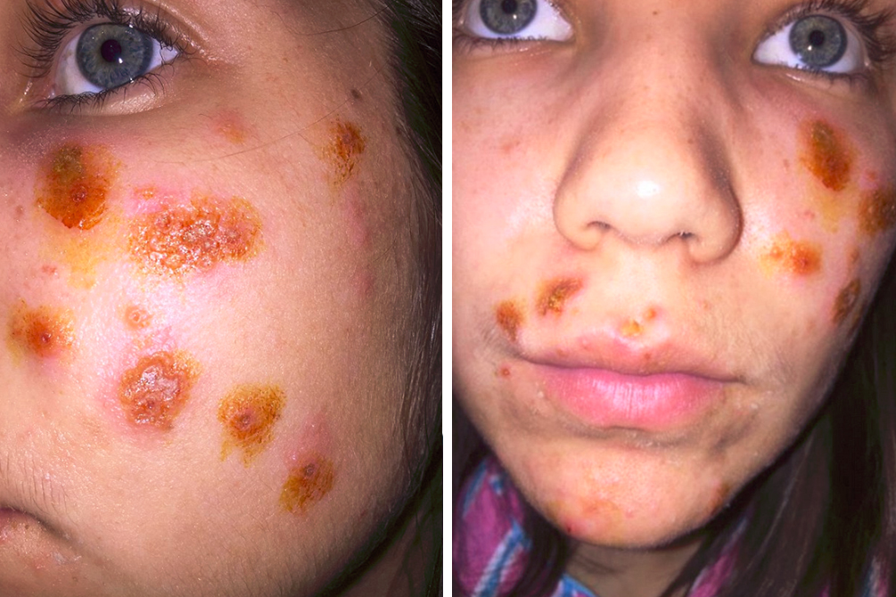 jovem-processo-peeling-quimico-03