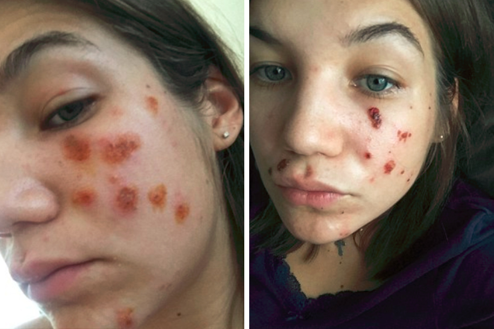 jovem-processo-peeling-quimico-04