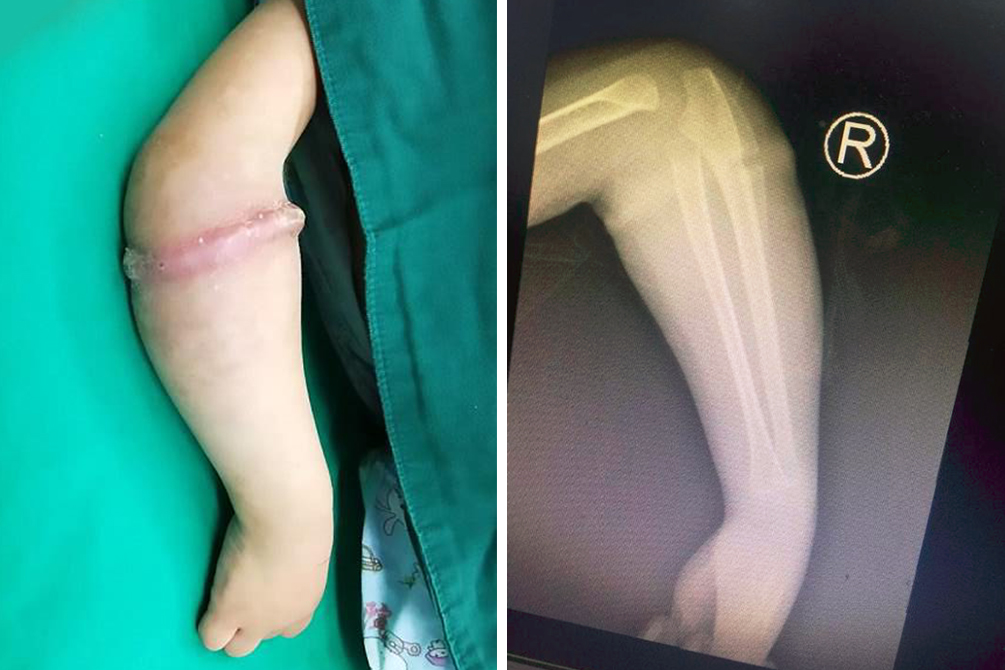 Médico faz alerta após descobrir objeto inesperado em braço de criança