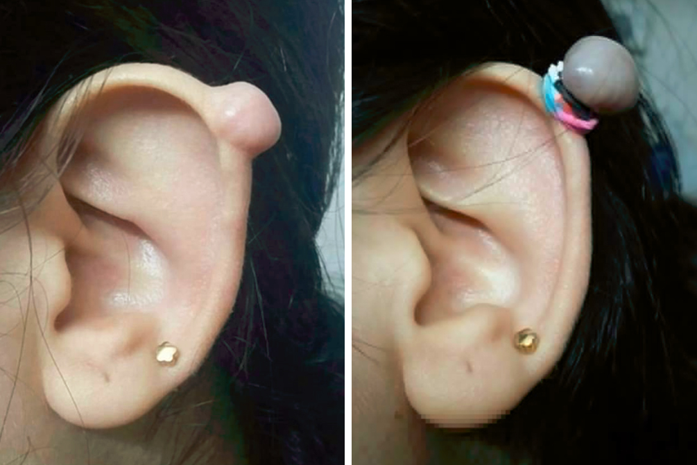 Jovens arriscam ao usar método caseiro para remover queloides