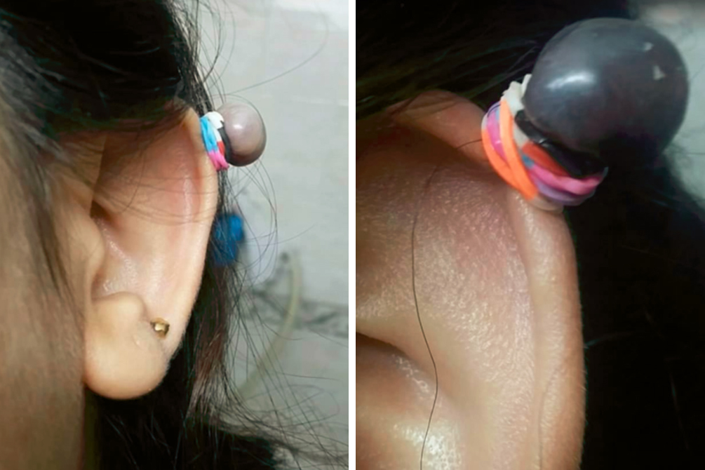 metodo-caseiro-remover-queloides-03