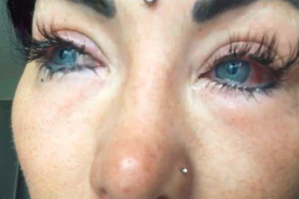 mulher-perde-visao-cirurgia-controversa-04