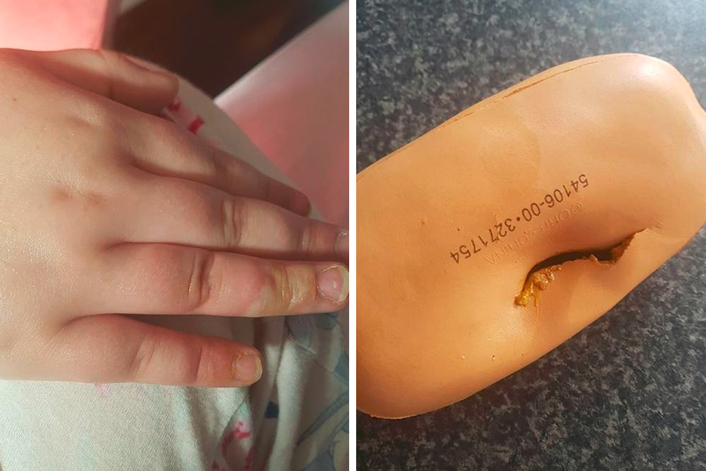 brinquedo-queimadura-quimica-03