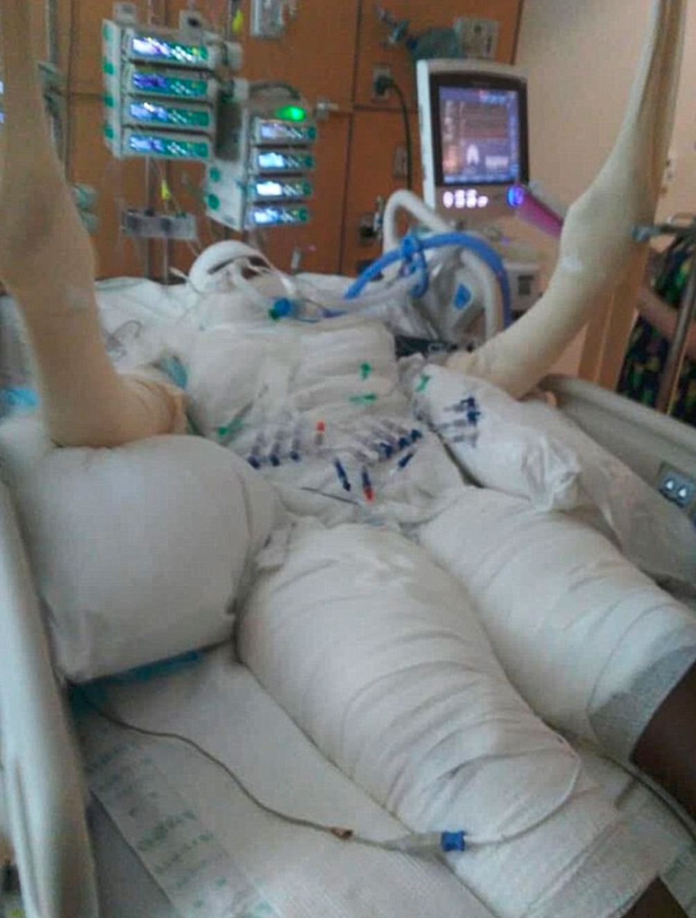 desafio-youtube-queimadura-03