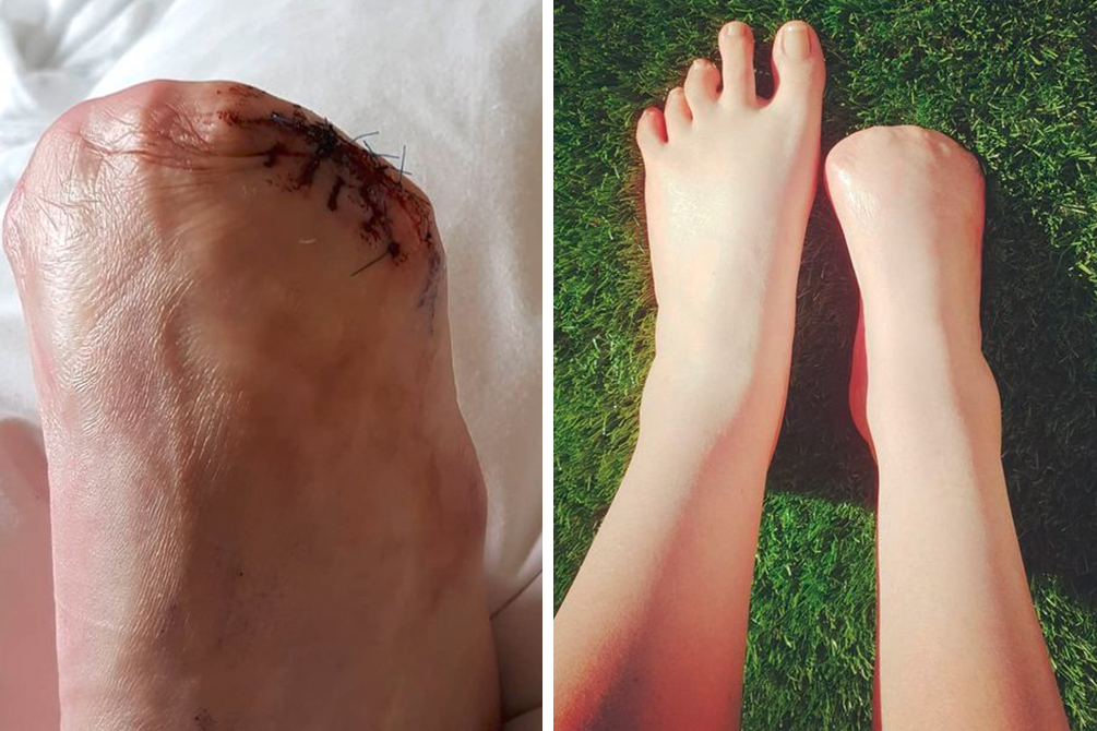 amputacao-dedos-spa-exterior-03