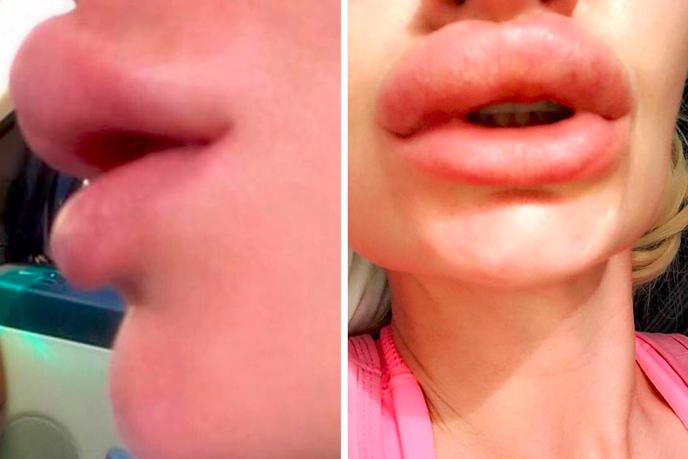 preenchimento-labial-03