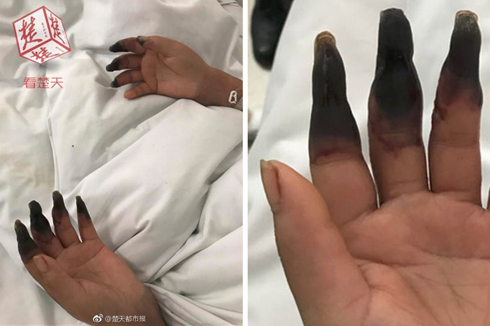 acidente-domestico-gangrena-03