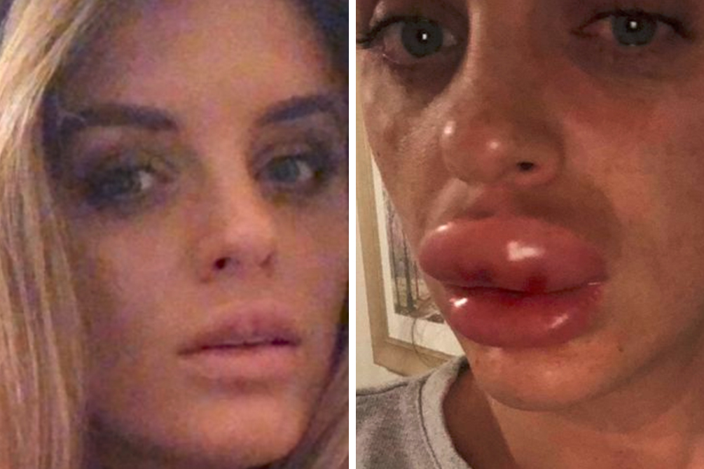 Mulher faz alerta após “festa do botox” que a levou ao hospital