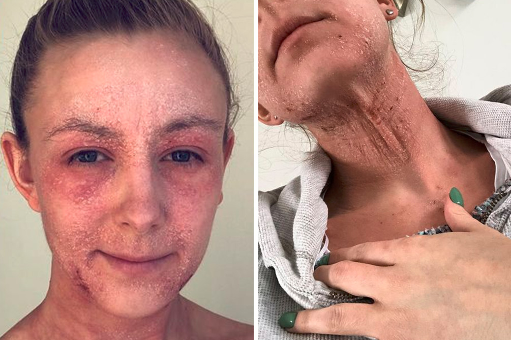 tratamento-eczema-03