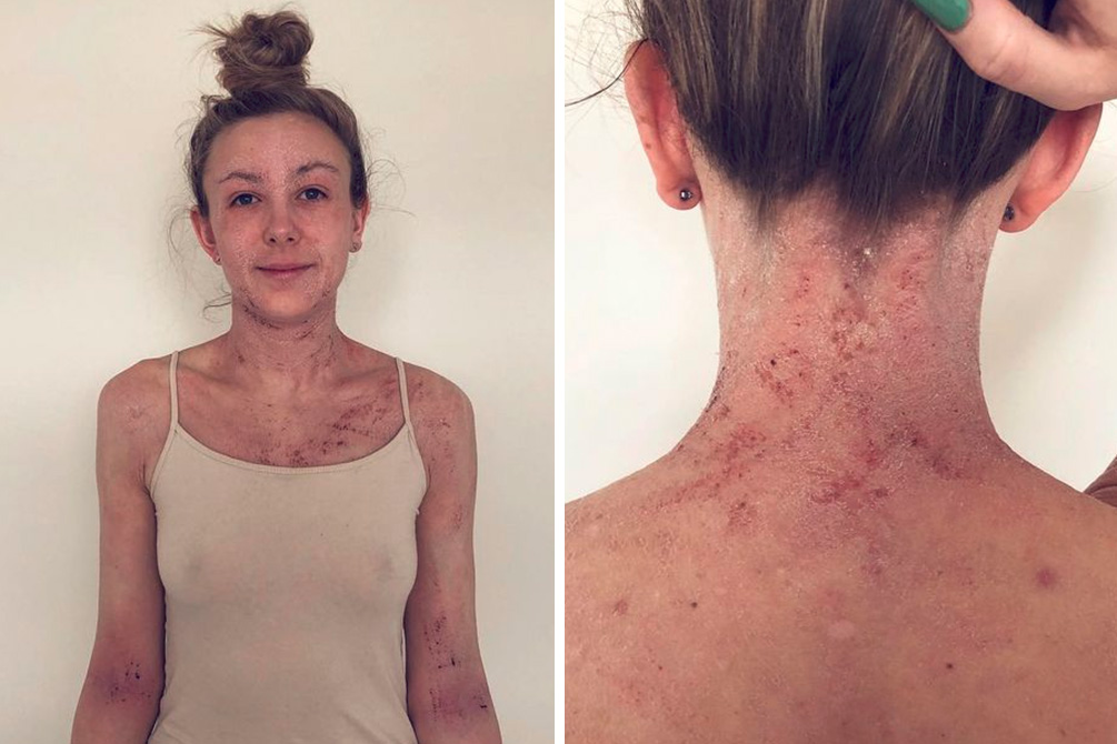 tratamento-eczema-04