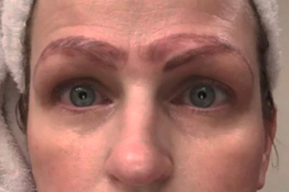 americana-quatro-sobrancelhas-procedimento-estetico-03